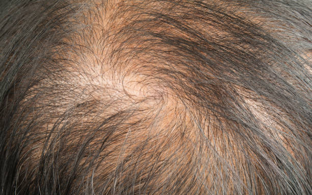 Female Pattern Baldness