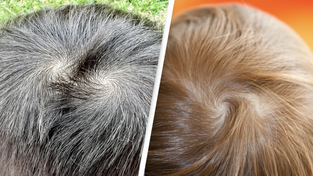 Hair Whorl or Balding