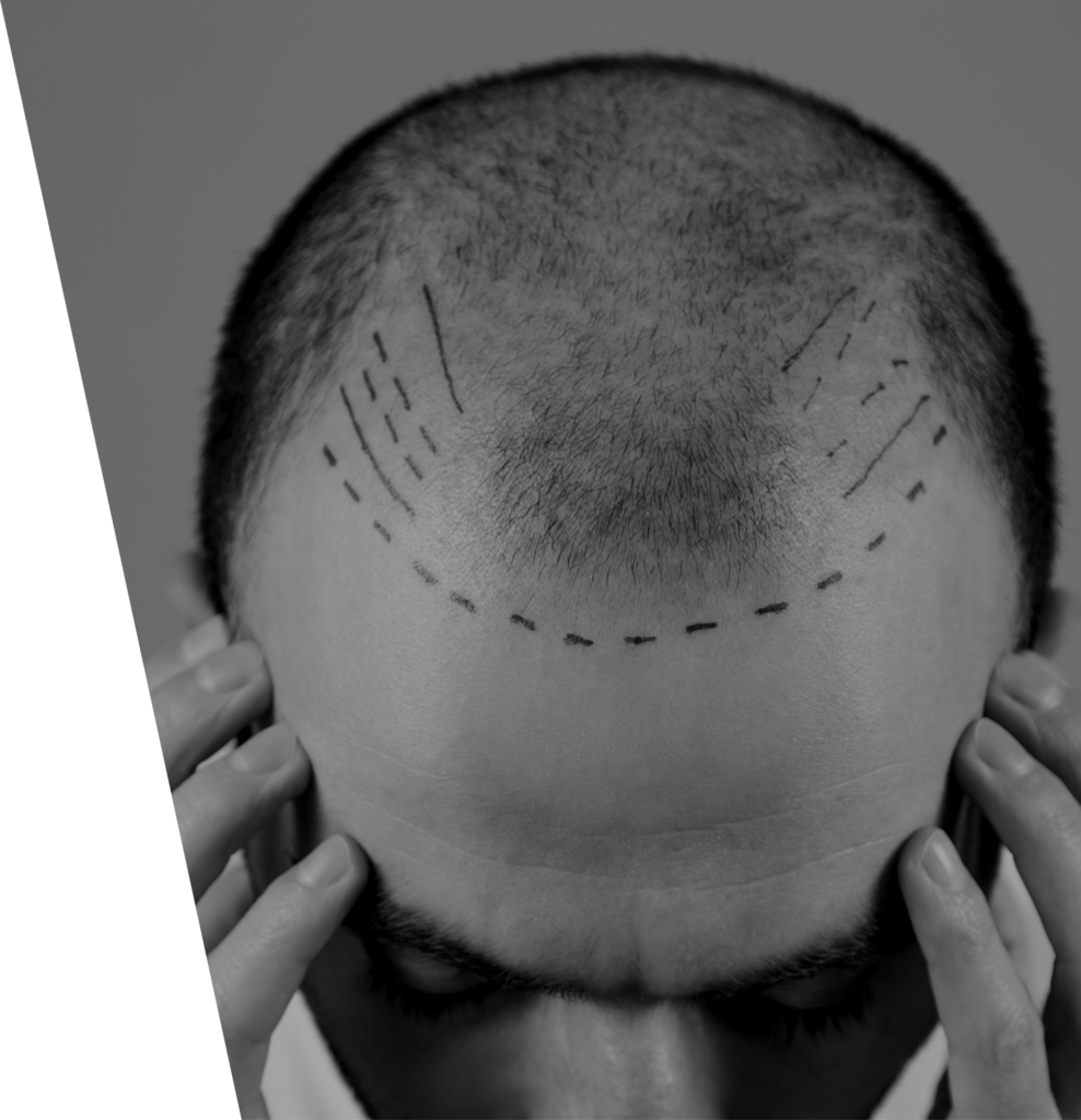 is scalp micropigmentation safe?