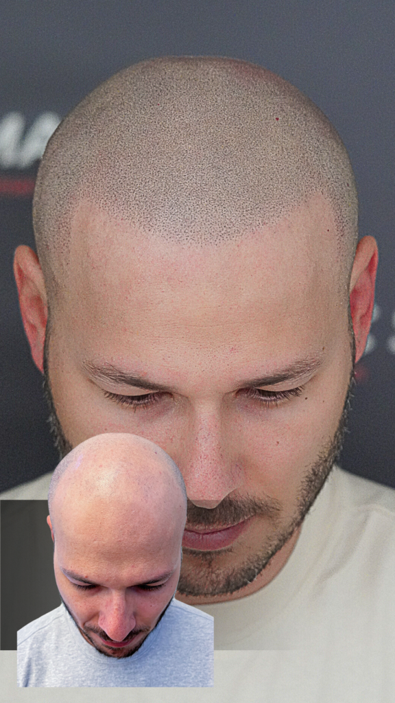 micro scalp pigmentation before and after