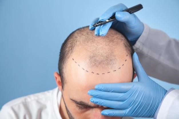 Hair Micropigmentation, Hair Tattoos in NYC: The Ultimate FAQ for New Yorkers