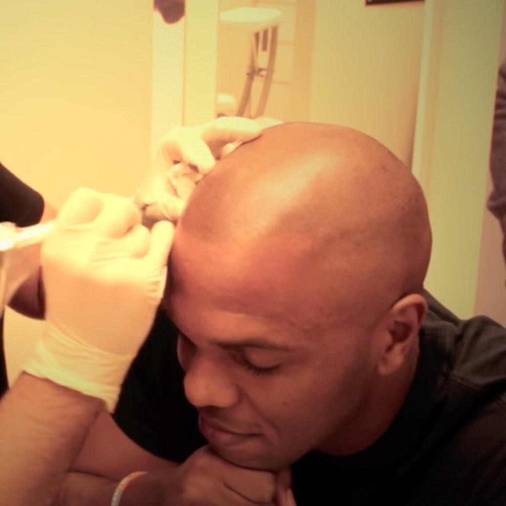 Celebs with SMP: 10 Celebrities Who Embrace Scalp Micropigmentation quinton 