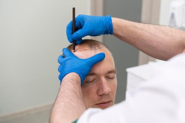 Does Scalp Biopsy Affect Micropigmentation Results?