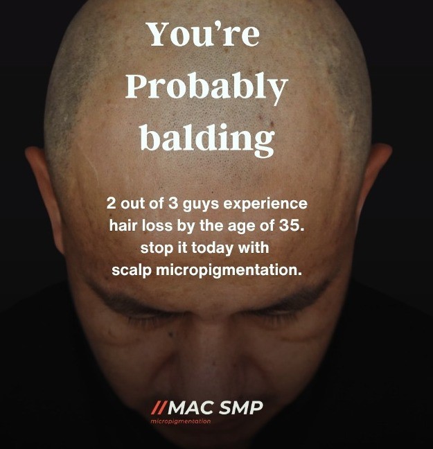 Scalp Micropigmentation New York Say Goodbye to Thinning Hair & Alopecia, Scalp Micropigmentation in New York