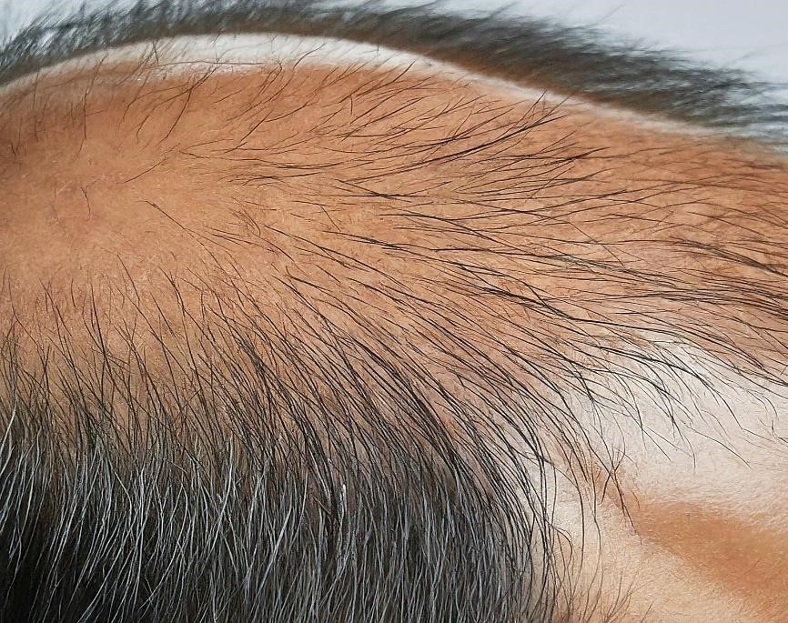 alopecia bald patches on the head