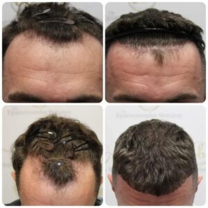 Real-Life Results of Hair Transplant in White Plains, New York: Success Stories and Before-and-After Photos