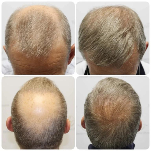 Real-Life Results of Hair Transplant in White Plains